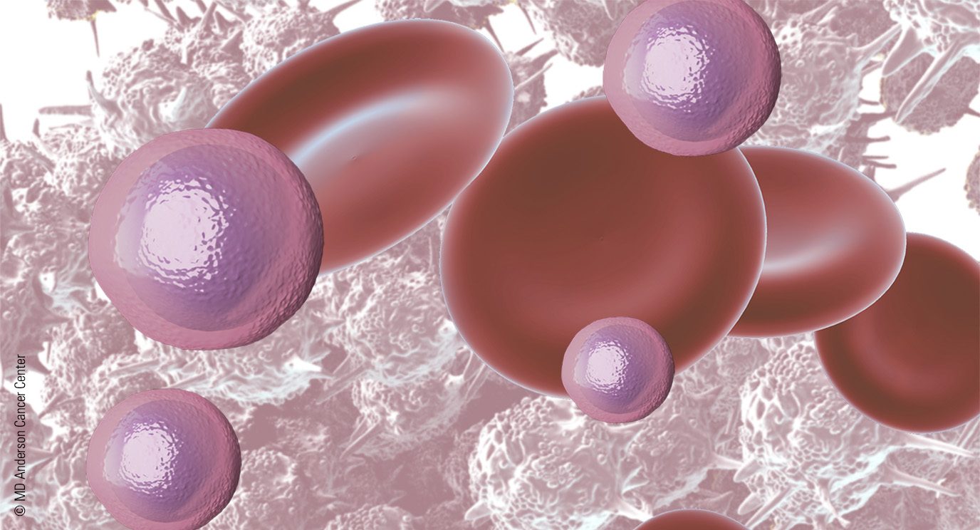 illustration of MALT lymphoma
