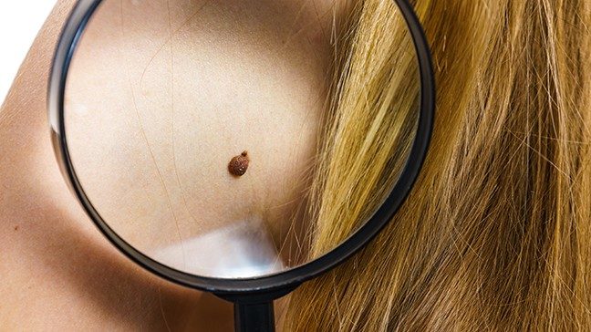 Small mole on woman's shoulder is shown under a magnifying glass.