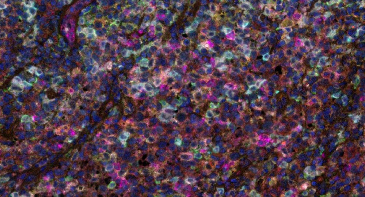 Pathological image of follicular lymphoma cells